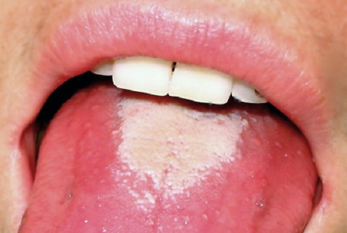 scarlatine